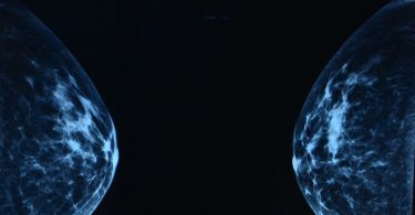 Scan from mammogram procedure